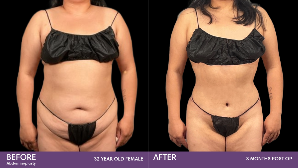 Tummy Tuck