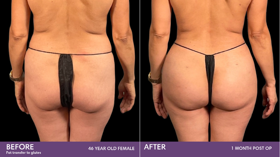 Brazilian Butt Lift