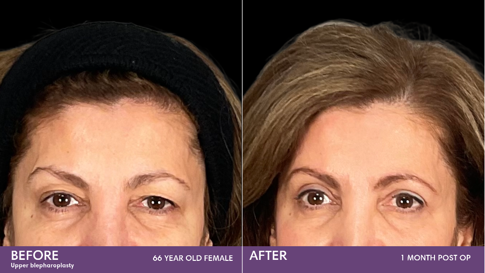 Blepharoplasty