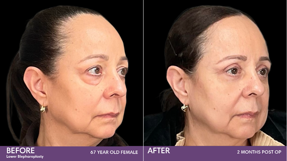 Blepharoplasty