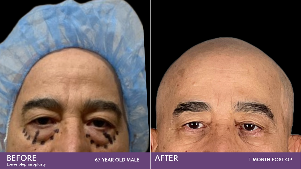 Blepharoplasty