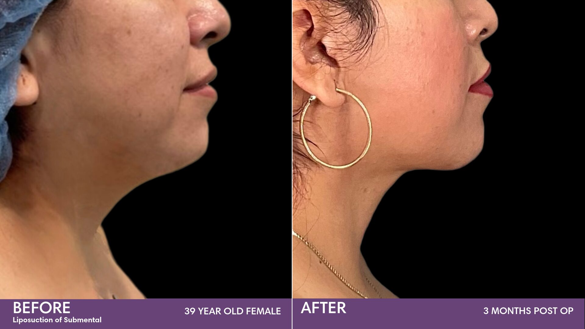 Chin Liposuction